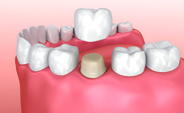 Best Dental Crowns Treatment In Old Spanish Trail Rd, Houston