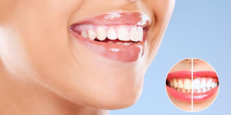 Teeth Whitening: What You Should Know Before Your Treatment