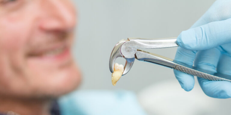 Tooth Extractions: When They’re Necessary and What to Expect