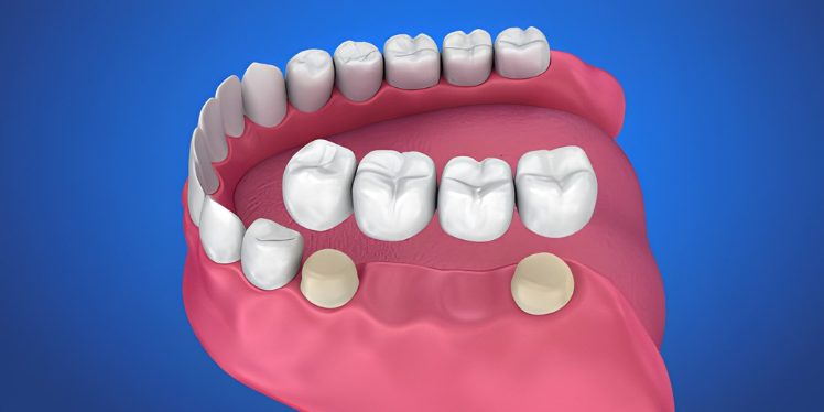 Dental Bridges for Multiple Missing Teeth: Treatment Options Explained