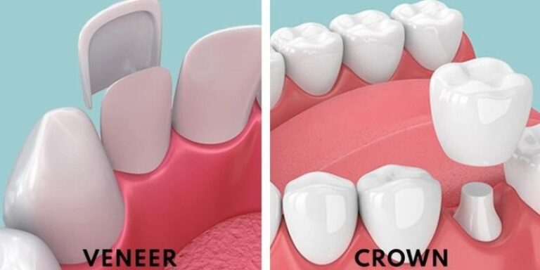 Veneers vs. Crowns: What’s the Difference and Which One Is Right for You?